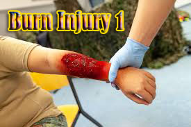 Burn Injury 1