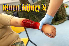 Burn Injury 2